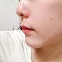 骨切り（あご） / 脂肪吸引（顔） / セットバック / ルフォー+ssro（両あご) リッツ美容外科 東京院 DAY 23 サムネイル用