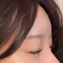 ヒアルロン酸注入（額） LA CLEF CLINIC（ラクレクリニック） DAY 2 サムネイル用