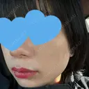 光治療（フォトフェイシャルなど） まゆりなclinic 名古屋栄 DAY 7 サムネイル用