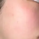 ピーリング（ニキビ・毛穴） LIFIX BEAUTY CLINIC AFTER サムネイル用