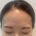 その他（目元） / ボトックス（エラ・小顔） 湘南美容クリニック 京都院 AFTER サムネイル用