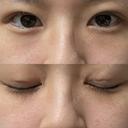 二重埋没 湘南美容クリニック 渋谷院 DAY 7 サムネイル用