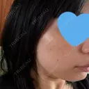 光治療（フォトフェイシャルなど） まゆりなclinic 名古屋栄 AFTER サムネイル用