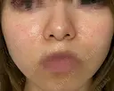 毛穴洗浄（ハイドラフェイシャルなど） / ポテンツァ A CLINIC（エークリニック） 銀座院 DAY 7 サムネイル用