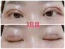 二重埋没 / 上まぶたの脂肪取り 湘南美容クリニック 奈良院 DAY 3 サムネイル用