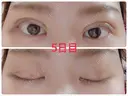 二重埋没 / 上まぶたの脂肪取り 湘南美容クリニック 奈良院 DAY 5 サムネイル用