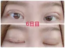 二重埋没 / 上まぶたの脂肪取り 湘南美容クリニック 奈良院 DAY 6 サムネイル用