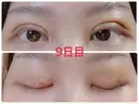 二重埋没 / 上まぶたの脂肪取り 湘南美容クリニック 奈良院 DAY 9 サムネイル用