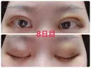 二重埋没 / 上まぶたの脂肪取り 湘南美容クリニック 奈良院 DAY 8 サムネイル用