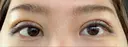 二重埋没 / 上まぶたの脂肪取り 湘南美容クリニック 奈良院 DAY 8 サムネイル用