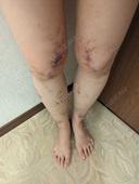 脂肪吸引（脚） / 豊胸（脂肪注入） オアシス美容外科 DAY 15 サムネイル用