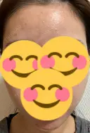 ヒアルロン酸注入（あご） / ヒアルロン酸注入（額） / ボトックス（眉間） / ピコレーザートーニング（美白・肝斑） THE FIRST CLINIC 多摩センター院 AFTER サムネイル用