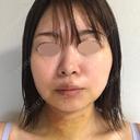 糸リフト / バッカルファット除去 / 脂肪吸引（顔） 湘南美容クリニック 京都院 DAY 4 サムネイル用