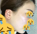 脂肪吸引（顔） / 額を丸く / 脂肪吸引（脚） / こめかみ形成 / 輪郭修正 / 脂肪注入（額） / 脂肪注入（輪郭） フレッシュ整形外科 DAY 17 サムネイル用