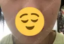 脂肪吸引（顔） 東京美専クリニック DAY 8 サムネイル用