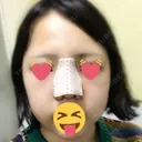 隆鼻術 / 鼻尖形成（切開） / 鼻中隔延長（切開） / 小鼻縮小（切開） / 軟骨移植 HANABI整形外科 AFTER サムネイル用