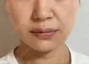 糸リフト / ヒアルロン酸注入（あご） ブルームクリニック（BLOOM CLINIC） AFTER サムネイル用