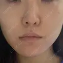 ほくろ・いぼ除去レーザー（肌） 心斎橋形成外科スキンケアクリニック AFTER サムネイル用