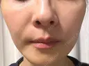 エレクトロポレーション / ピコレーザートーニング（美白・肝斑） 湘南美容クリニック 静岡院 AFTER サムネイル用