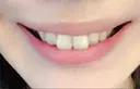 ガミースマイル手術 / その他（審美歯科/矯正歯科） / その他（口元） 有楽町美容外科クリニック DAY 4 サムネイル用