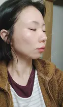 糸リフト / その他（輪郭） / ヒアルロン酸注入（鼻翼基部） 東京シンデレラ美容外科 池袋院 DAY 3 サムネイル用