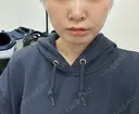 糸リフト / ヒアルロン酸注入（頬） EMMA CLINIC（エマクリニック） AFTER サムネイル用