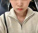 糸リフト / ヒアルロン酸注入（頬） EMMA CLINIC（エマクリニック） DAY 9 サムネイル用