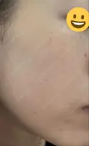 イオン導入 / ピーリング（ハリ・ツヤ） / ルメッカ ルラ美容クリニック 大阪本院 DAY 0 サムネイル用