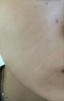イオン導入 / ピーリング（ハリ・ツヤ） / ルメッカ ルラ美容クリニック 大阪本院 AFTER サムネイル用