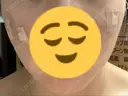 脂肪吸引（顔） 東京美専クリニック DAY 18 サムネイル用