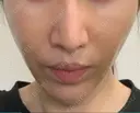 脂肪吸引注射（顔） イテウォンビューティークリニック 名古屋栄院 DAY 7 サムネイル用