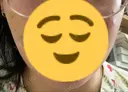 脂肪吸引（顔） 東京美専クリニック DAY 21 サムネイル用