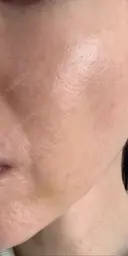 脂肪吸引注射（顔） イテウォンビューティークリニック 名古屋栄院 DAY 10 サムネイル用