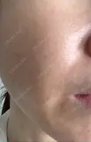 脂肪吸引注射（顔） イテウォンビューティークリニック 名古屋栄院 DAY 10 サムネイル用