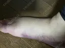 脂肪吸引（脚） / 脂肪吸引（お尻） 湘南美容クリニック 京都院 DAY 4 サムネイル用