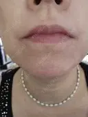 ヒアルロン酸注入（涙袋） / ボトックス（エラ・小顔） / ボトックス（眉間） / ボトックス（額） / ハイフ（顔） ルラ美容クリニック 東京駅前院 AFTER サムネイル用