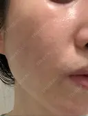 脂肪吸引注射（顔） イテウォンビューティークリニック 名古屋栄院 DAY 11 サムネイル用