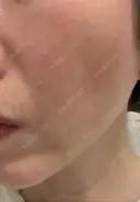 脂肪吸引注射（顔） イテウォンビューティークリニック 名古屋栄院 DAY 11 サムネイル用