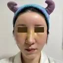 糸リフト / 額を丸く / 真皮移植 / 脂肪注入（額） / 切開リフト / 脂肪注入（輪郭） eクリニック 金沢本院 DAY 3 サムネイル用