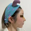 糸リフト / 額を丸く / 真皮移植 / 脂肪注入（額） / 切開リフト / 脂肪注入（輪郭） eクリニック 金沢本院 DAY 3 サムネイル用