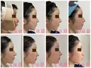 糸リフト / 額を丸く / 真皮移植 / 脂肪注入（額） / 切開リフト / 脂肪注入（輪郭） eクリニック 金沢本院 DAY 7 サムネイル用