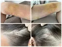 糸リフト / 額を丸く / 真皮移植 / 脂肪注入（額） / 切開リフト / 脂肪注入（輪郭） eクリニック 金沢本院 DAY 7 サムネイル用