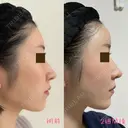 糸リフト / 額を丸く / 真皮移植 / 脂肪注入（額） / 切開リフト / 脂肪注入（輪郭） eクリニック 金沢本院 DAY 14 サムネイル用