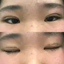 二重埋没 城本クリニック 富山院 DAY 0 サムネイル用