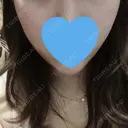 糸リフト / ヒアルロン酸注入（あご） / ボトックス（エラ・小顔） / 脂肪溶解注射（顔） TCB東京中央美容外科 郡山院 DAY 9 サムネイル用