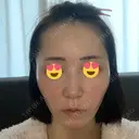 ハイフ（顔） 心斎橋形成外科スキンケアクリニック AFTER サムネイル用