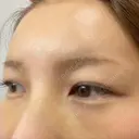 ヒアルロン酸注入（額） LA CLEF CLINIC（ラクレクリニック） DAY 6 サムネイル用