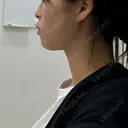 糸リフト / 脂肪吸引（顔） BLINC CLINIC （ブリンク クリニック） AFTER サムネイル用