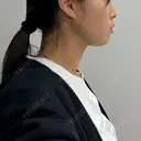 糸リフト / 脂肪吸引（顔） BLINC CLINIC （ブリンク クリニック） DAY 37 サムネイル用