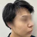 ルメッカ シェリークリニック 新宿本院 AFTER サムネイル用